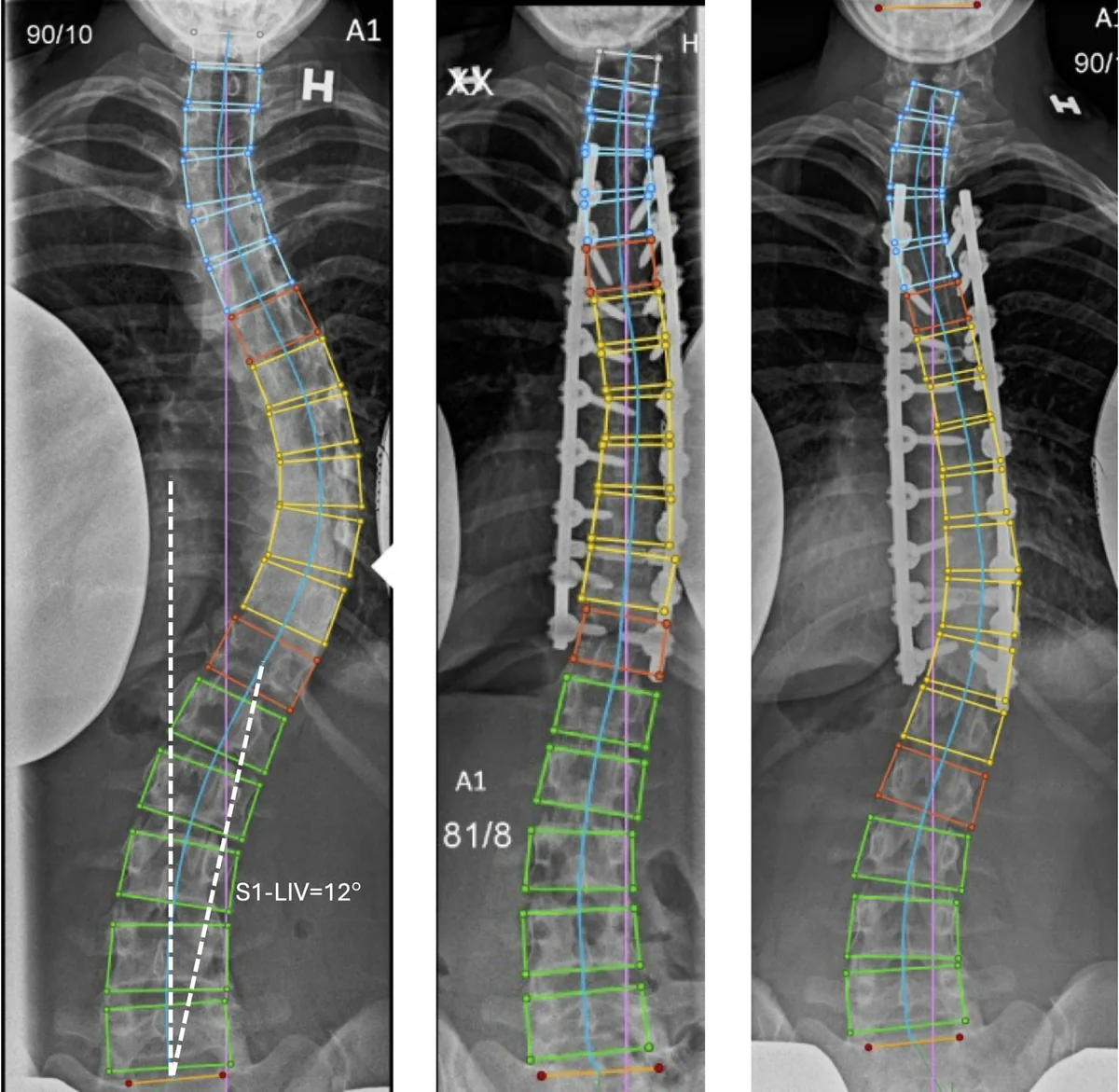 A 55-degree Lenke 1A curve with an S1-LIV angle of 12 degrees. The last touched vertebra was L1. The patient was operated with a Th4-Th12 fusion with good immed