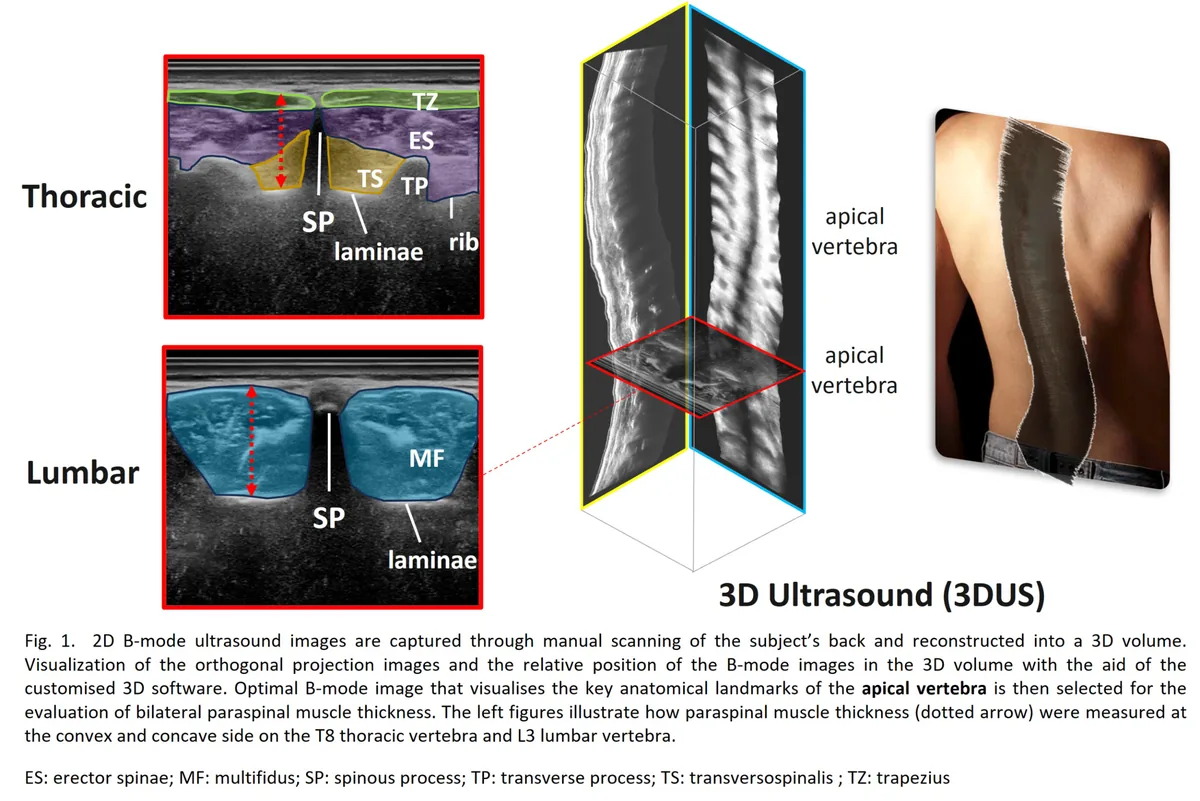 Fig. 1. 2D B-mode ultrasound images are captured through manual scanning of the subject's back and reconstructed into a 3D volume. Visualization of the orthogon