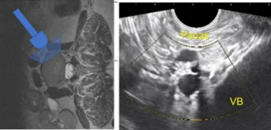 Ultrasound in mini open OLIF und lateral ALIF.