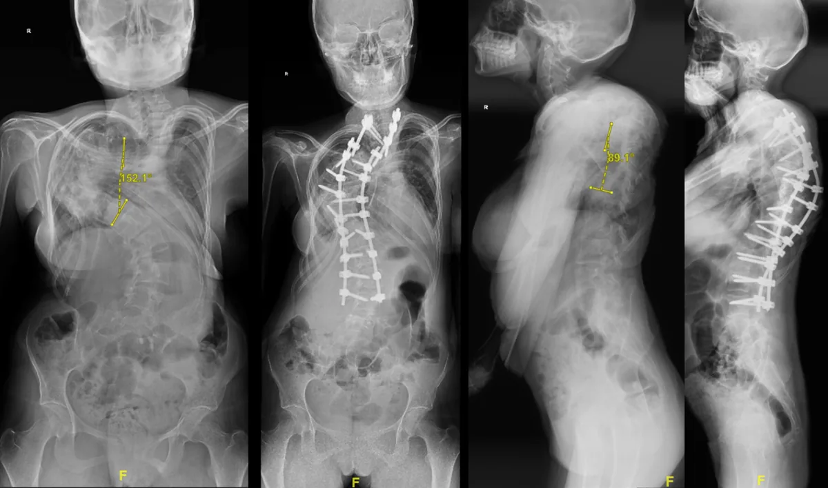 Preoperative and postoperative full-spine AP and lateral radiographs of a 24-year-old female patient who underwent two months of halo-gravity traction followed 