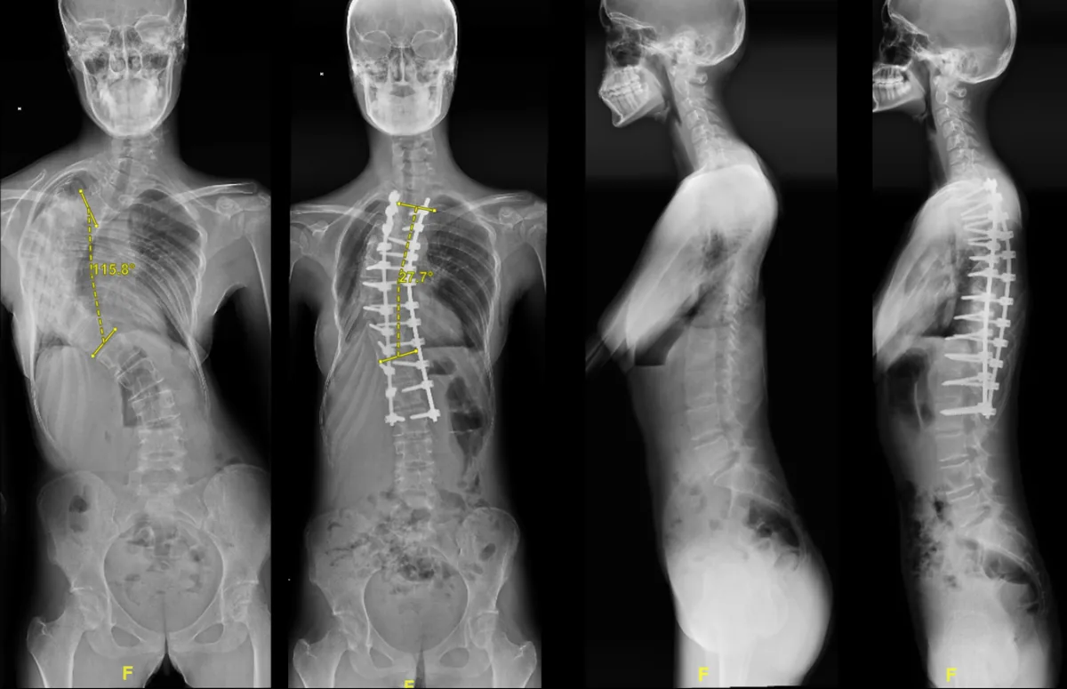 Preoperative and postoperative full-spine AP and lateral radiographs of a 19-year-old female patient who underwent T8 PVCR