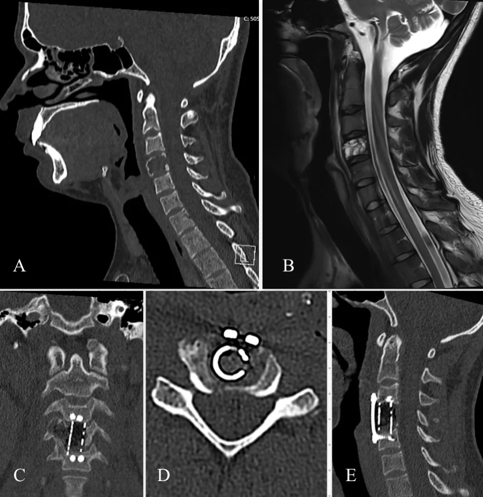 Figure 1: Preoperative and early postoperative imaging of a 22-year-old male patient with a lytic lesion of the C4 vertebral body.(A) Preoperative sagittal CT s