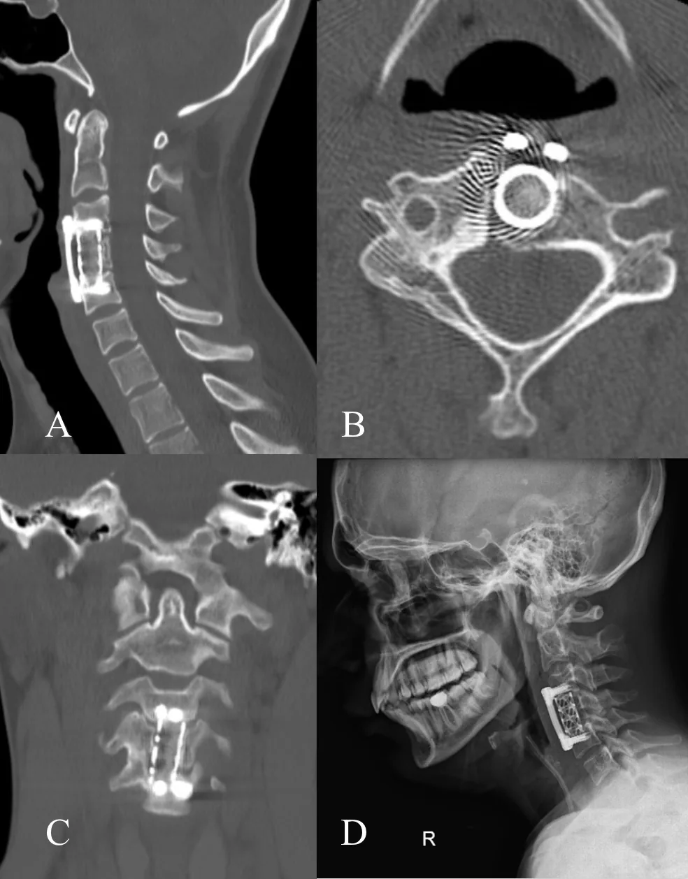 Figure 2: One-year follow-up imaging of the same patient shown in Figure 1.(A) Sagittal CT image demonstrating stable implant position and maintained cervical a