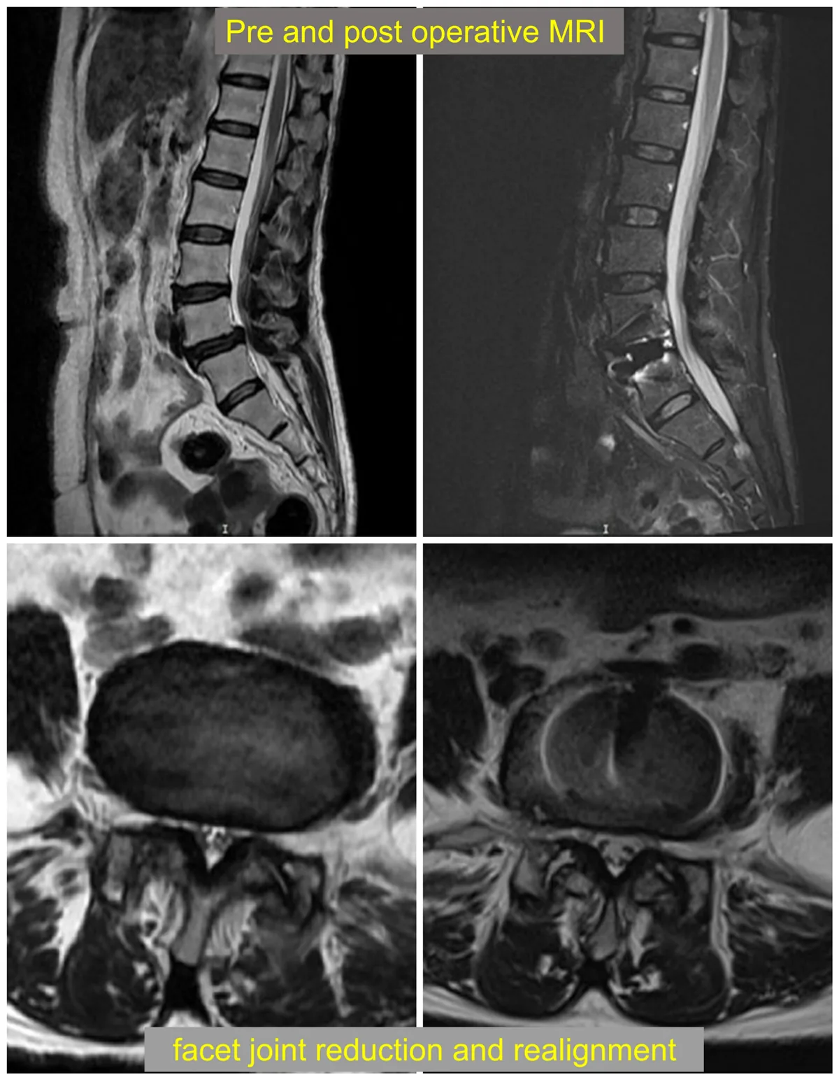 Pre and post operative MRI with indirect decompression by ligamentotaxis and reduction of facet joint subluxation and restoration of facet joint alignment