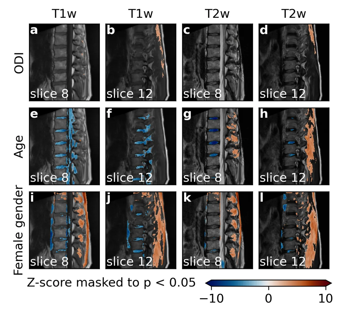 Association between MRI signal intensities and ODI, age, and female gender in patients with LSS. For each variable and MRI signal weighting, two sagittal slices