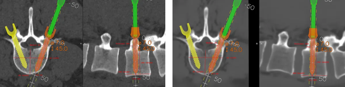 Fig 1) The dual navigation setup in the operation room. One system had the preoperative CT loaded, the other the sCT loaded as a shadow system. Fig 2) The two i