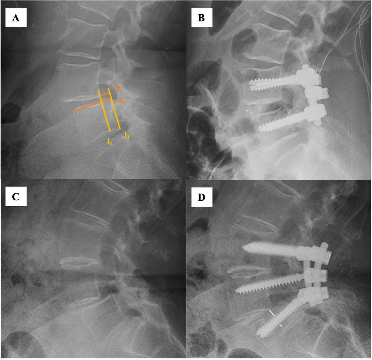 Figure 1. Radiographic assessment of segmental slippage on upright standing lateral lumbar radiographs. Panels A and B show preoperative and postoperative image