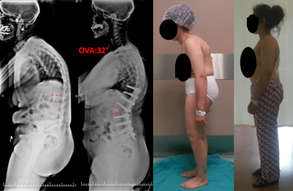29-year-old female patient with ankylosing spondylitis: preoperative and postoperative radiological and clinical images following L2 pedicle subtraction osteoto