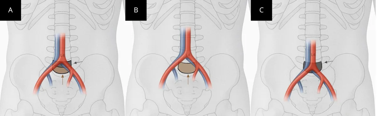 Level-specific anterior access strategy for L5 corpectomy according to the aortoiliac bifurcation. (A) Standard bifurcation at L4: the superior portion of L5 is