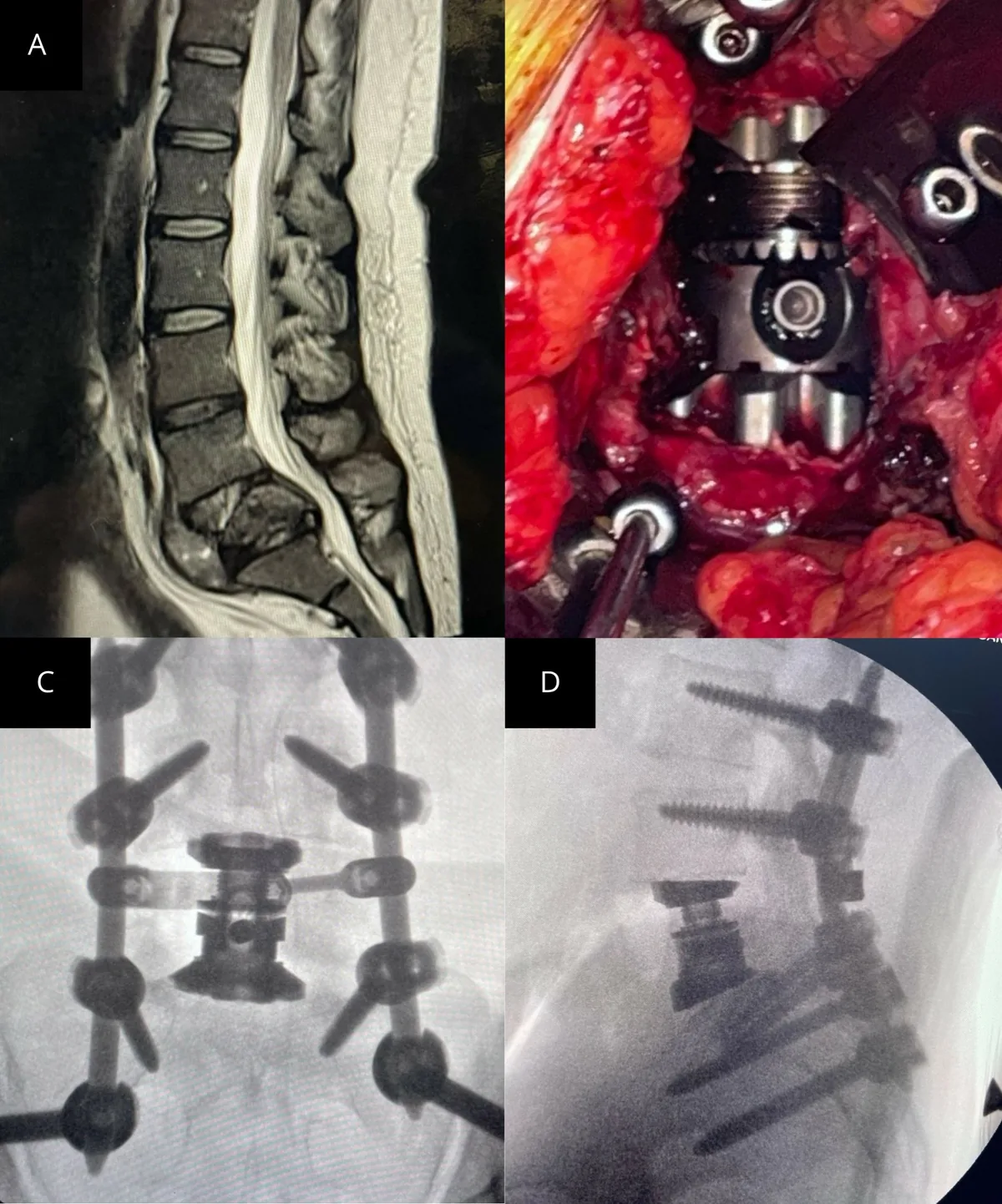 Anterior corpectomy with anterior column reconstruction and posterior stabilization. (A) Preoperative sagittal MRI demonstrating vertebral body collapse with ca