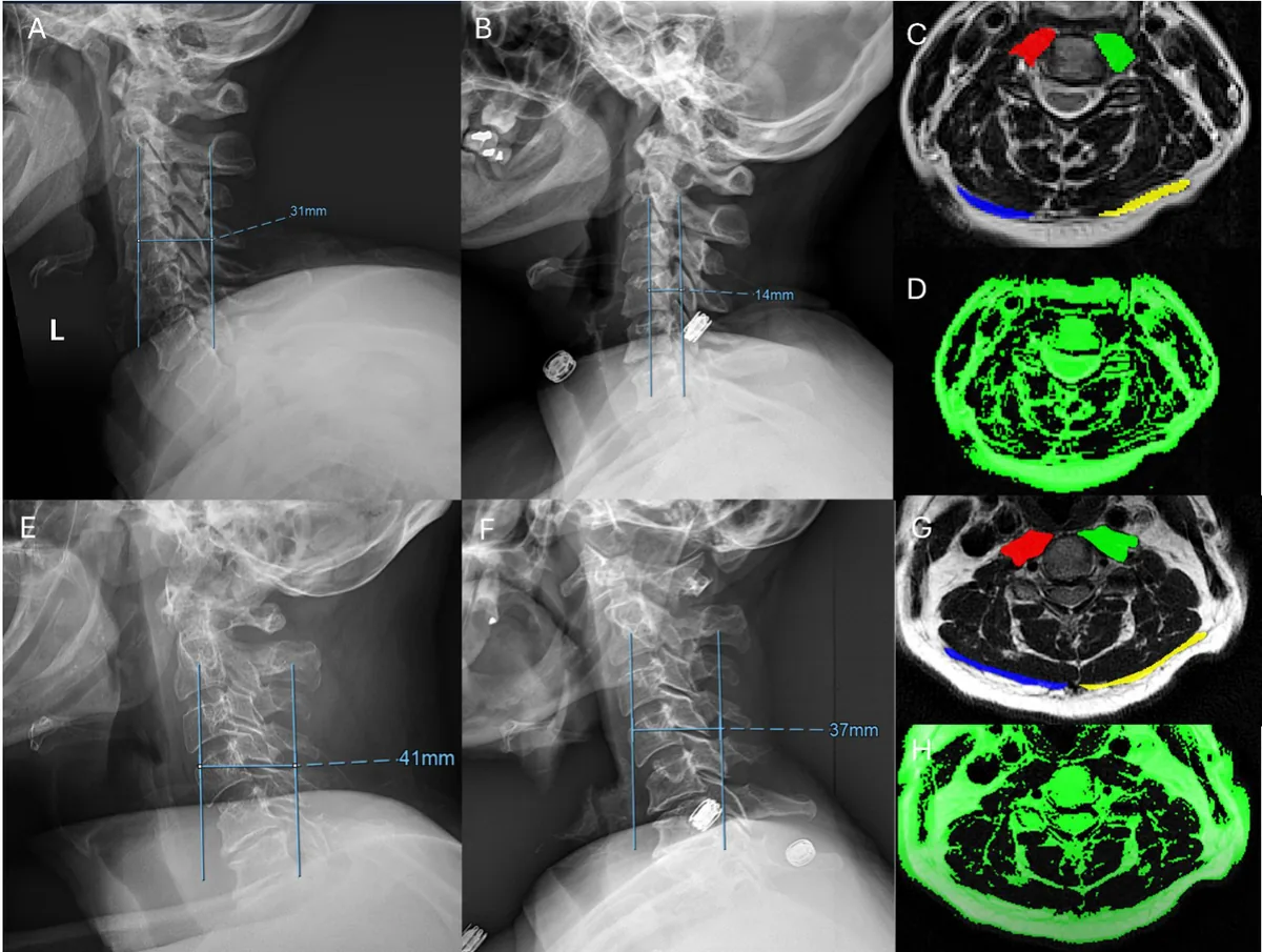 Representative examples of patients with contrasting cervical muscle morphologies and corresponding differences in immediate postoperative change in cervical sa