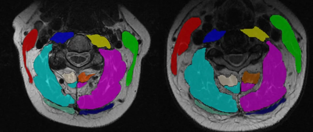 Axial MRI segmented image for 2 different patients at C3. Red: right sternocleidomastoid; green: left sternocleidomastoid; blue: right anterior muscle group; ye