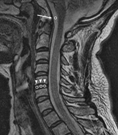 Representative ROI measurements of the disc and CSF signal intensities on T2- weighted midsagittal MRI images. Illustrative images of ROI measurements of the di
