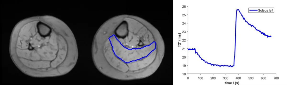 Figure 1. MRI images of the calfs showing the delineated region of interest (blue) in the soleus muscle of the cuff‑compressed leg. The plot displays the corres
