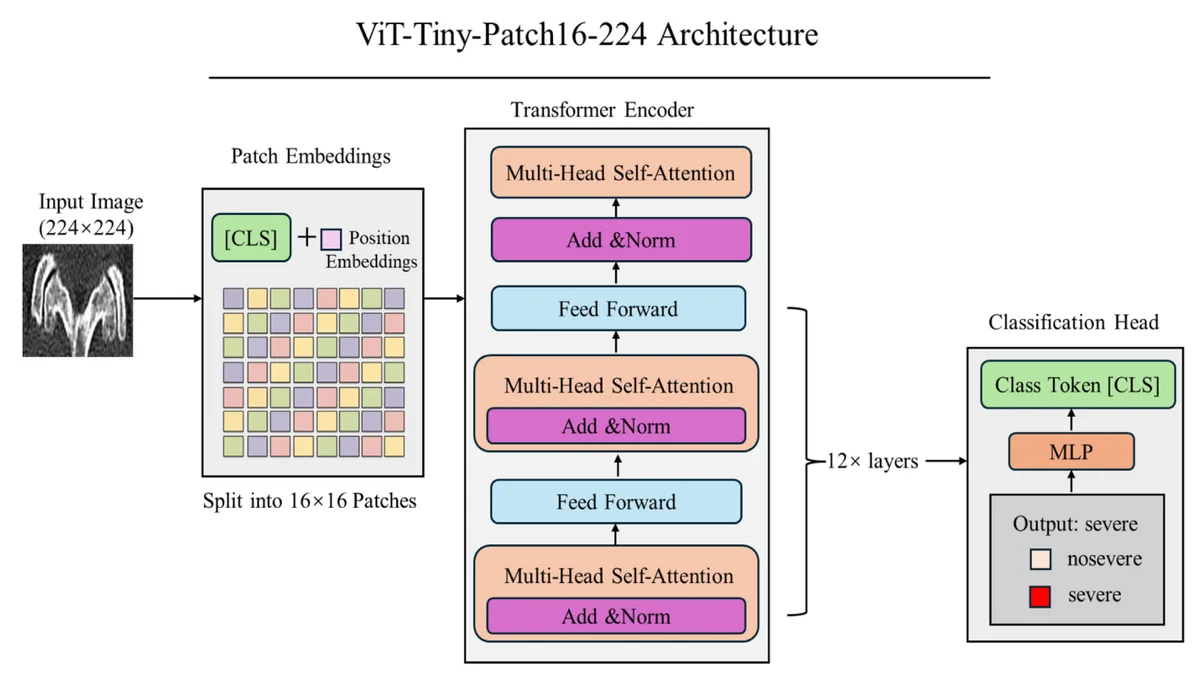 Figure 1. Architecture of the ViT-Tiny-Patch16-224 model. Schematic illustration of the Vision Transformer (ViT-Tiny-Patch16-224) architecture used for lumbar f
