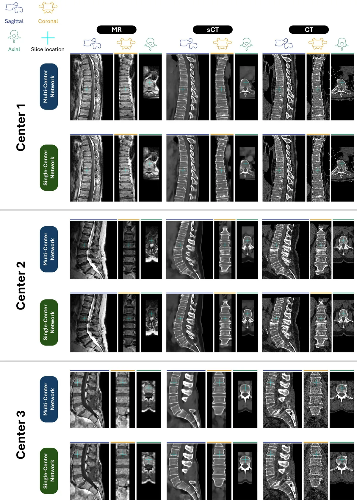 Figure 1: Qualitative examples of sCTs predicted by the Multi-Center Networks and Single-Center Networks per center. The MR inputs were sagittal 2D acquired sca
