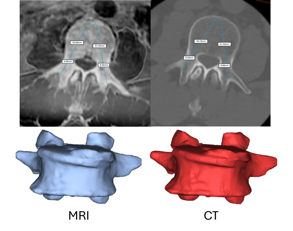 Fig 1: Pedicle screw measures & 3D geometry on CT-like MRI (left) & CT (right)