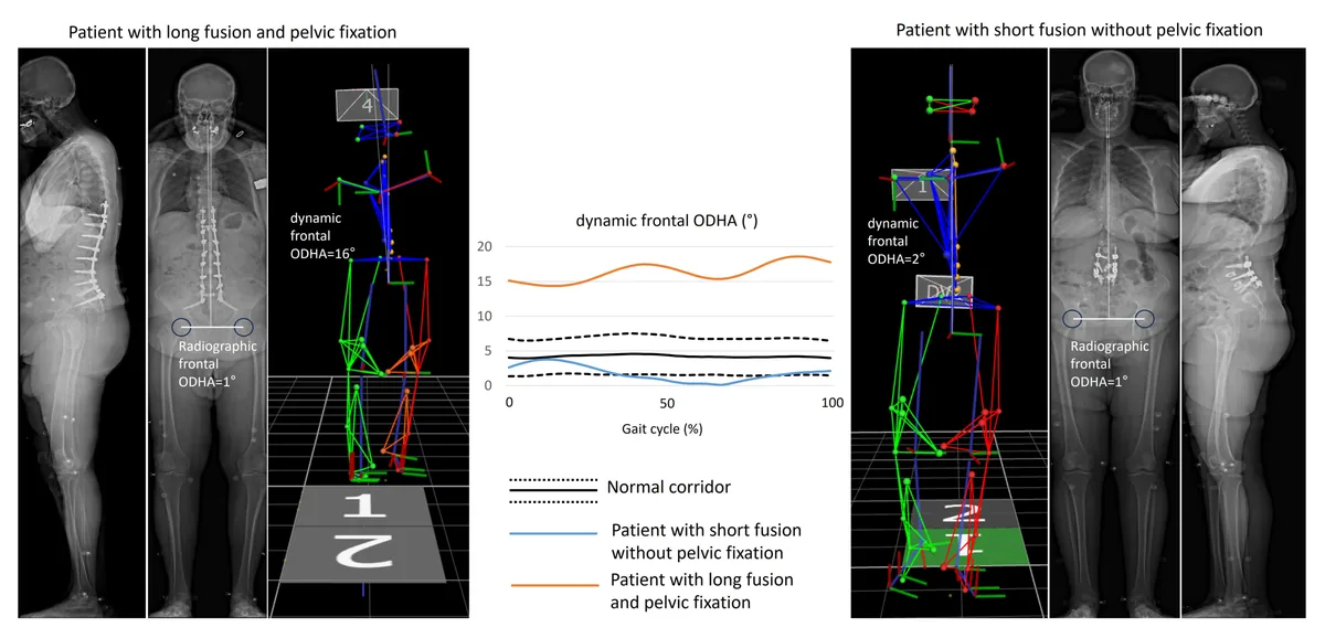 Figure 1: Examples of posteoperative ASD patients: with long fusion and pelvis fixation (left), with short fusion without pelvic fixation (right), and their fro