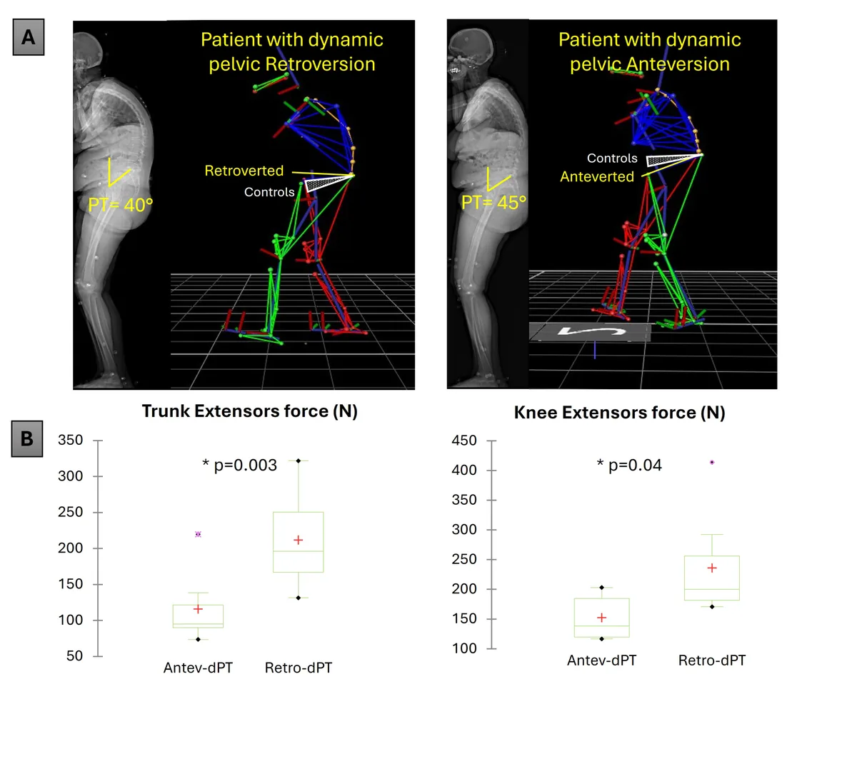 Fig.1: A) examples of patients with retroverted and anteverted dynamic pelvic tilt and comparable radiographic profiles. B) Trunk and knee extensors force.