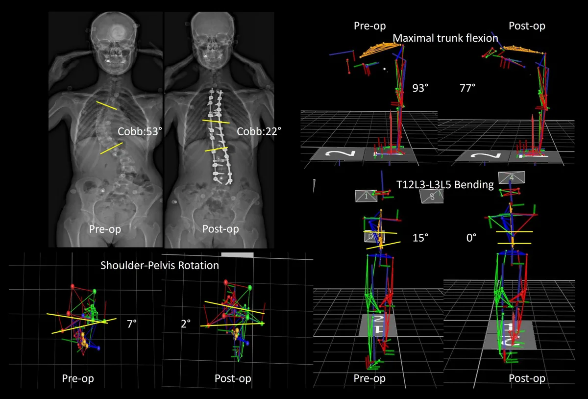 Figure.1- Comparison of radiographic and kinematic parameters during functional movement at preoperative and postoperative analysis
