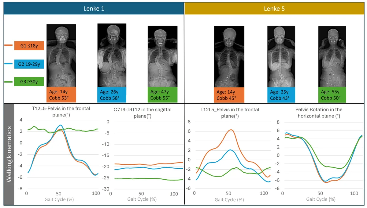 Fig.1: Examples of kinematic changes with age in scoliotic patients.