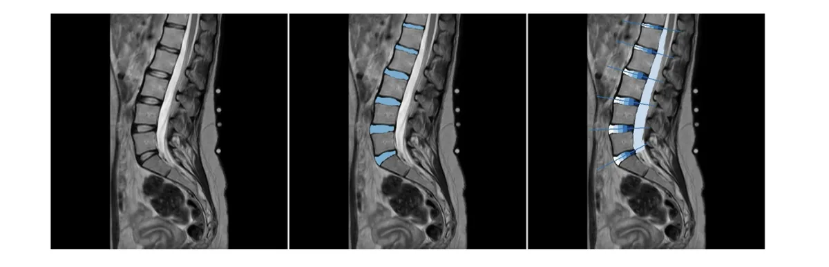 Figure 1: Exemplary T2 sagittal MRI-based assessment of lumbar intervertebral discs (L1–S1) illustrating disc measurements and zonal subdivision of individual d