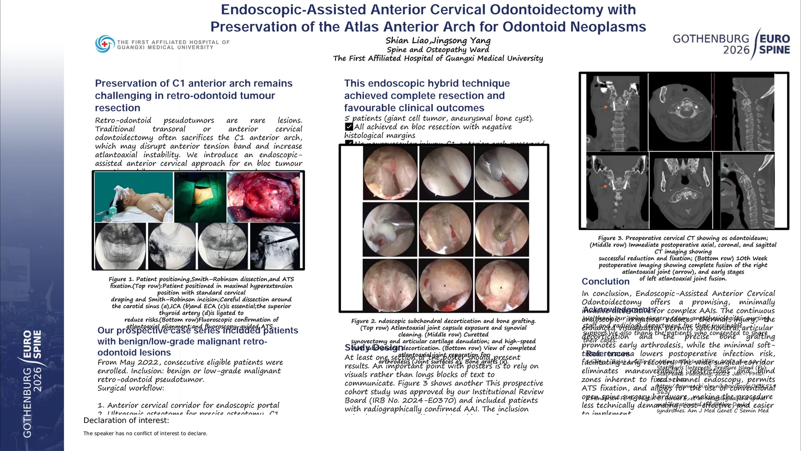 Poster 000077: Endoscopic-Assisted Anterior Cervical Odontoidectomy with Preservation of the Atlas Anterior Arch for Odontoid Neoplasms