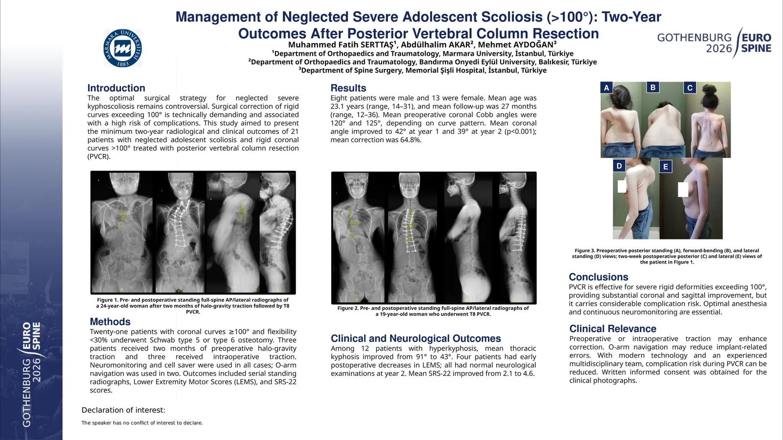 Poster 000324: Management of Neglected Severe Adolescent Scoliosis (>100°) : Two-Year Outcomes After Posterior Vertebral Column Resection